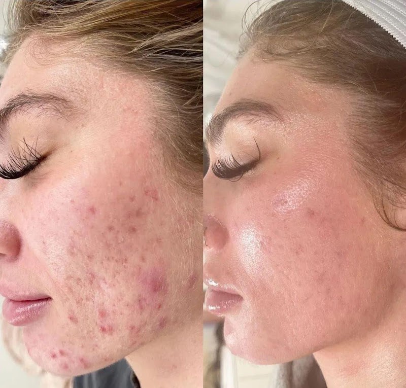 Collage Renewal Skin Needling & LED (Face)