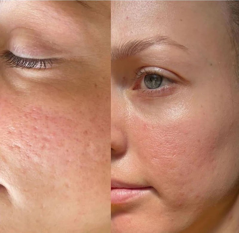 Skin Needling & LED (Face) [3+1 Package] - Image 1