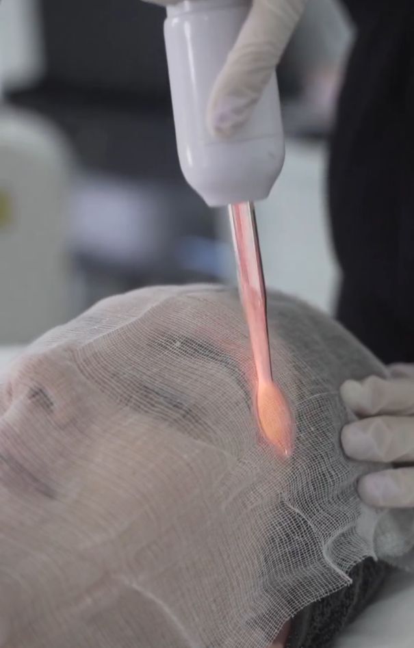 High Frequency Clarifying Therapy (Add-on) - Image 1