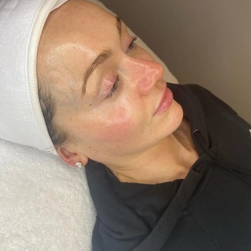 Aquapure Hydrodermabrasion [3+1 Package] - Image 5