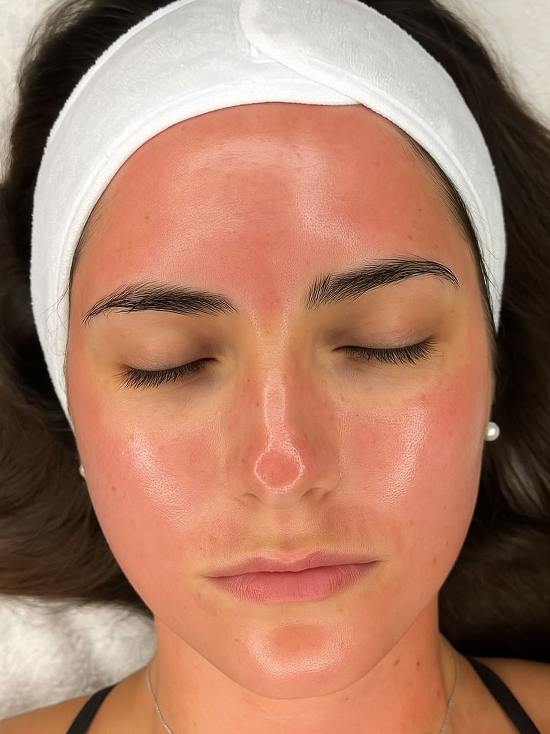 Skin Needling & LED (Face) [3+1 Package]