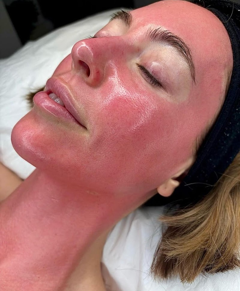 Collage Renewal Skin Needling & LED (Face, Neck & Decolletage)