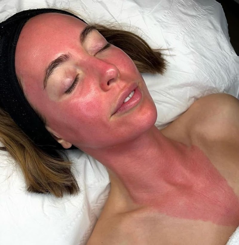 Skin Needling & LED (Face, Neck & Decolletage) [Package] - Image 1